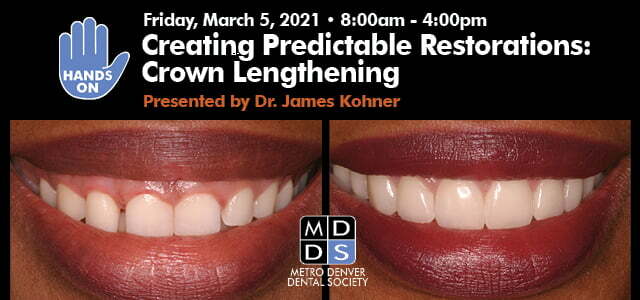 hands on crown lengthening course